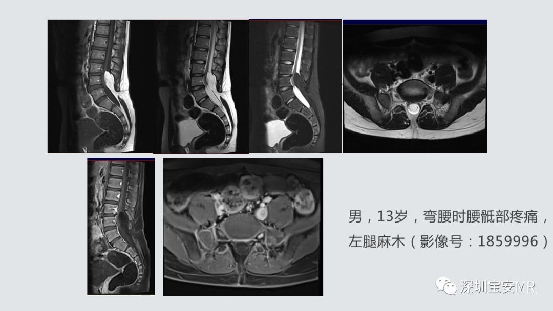 影像PPT - 【PPT】隐性神经管闭合不全的影像诊断-15