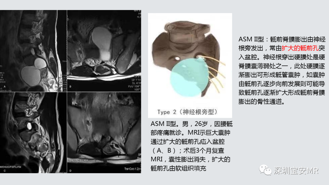 影像PPT - 【PPT】隐性神经管闭合不全的影像诊断-11
