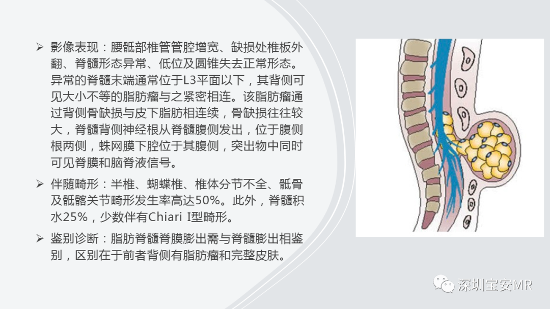 影像PPT - 【PPT】隐性神经管闭合不全的影像诊断-14