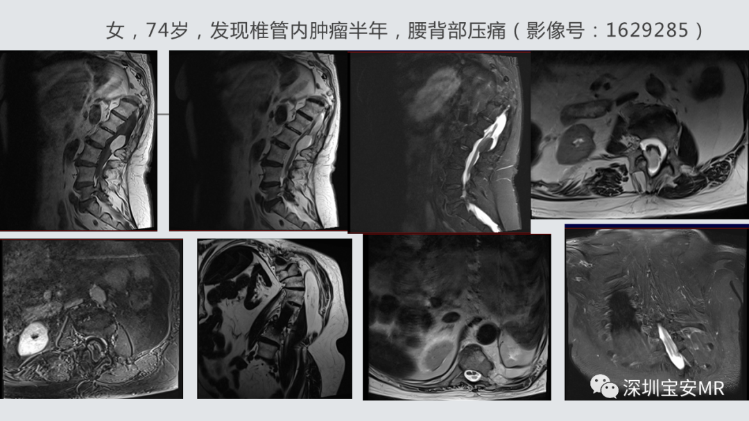 影像PPT - 【PPT】隐性神经管闭合不全的影像诊断-17