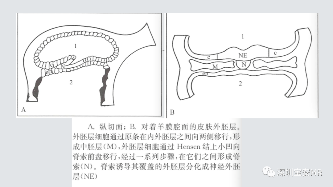 影像PPT - 【PPT】隐性神经管闭合不全的影像诊断-19