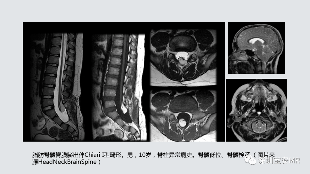 影像PPT - 【PPT】隐性神经管闭合不全的影像诊断-16