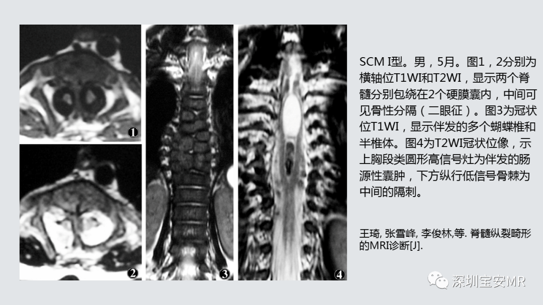 影像PPT - 【PPT】隐性神经管闭合不全的影像诊断-21