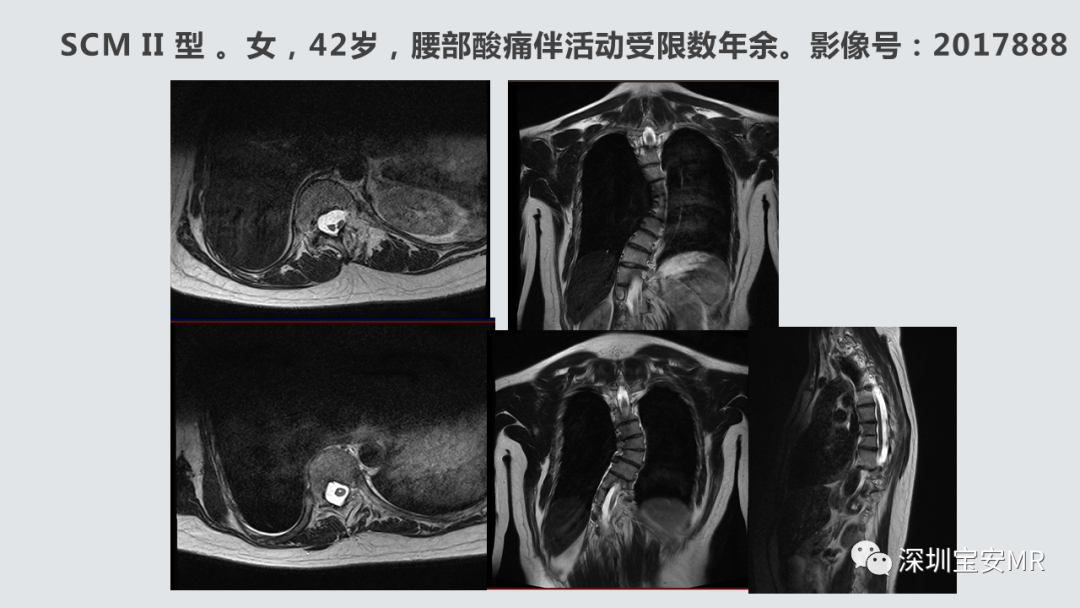 影像PPT - 【PPT】隐性神经管闭合不全的影像诊断-22