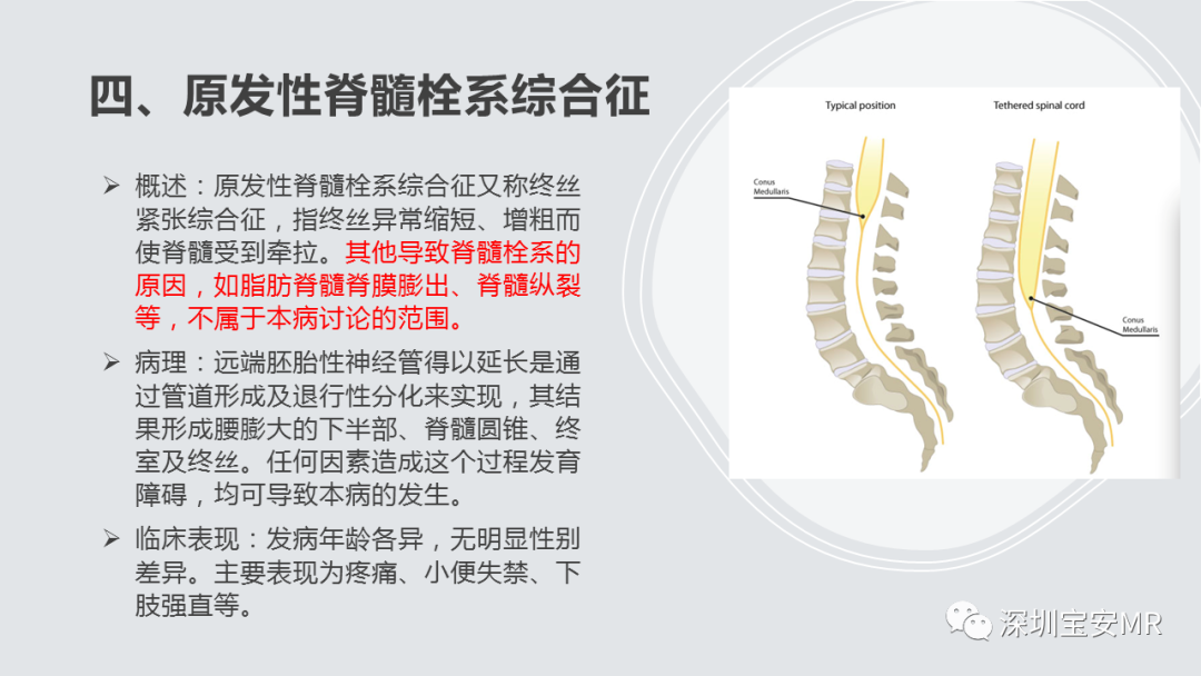 影像PPT - 【PPT】隐性神经管闭合不全的影像诊断-23