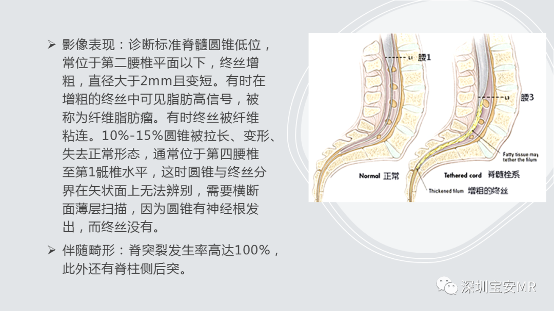 影像PPT - 【PPT】隐性神经管闭合不全的影像诊断-24