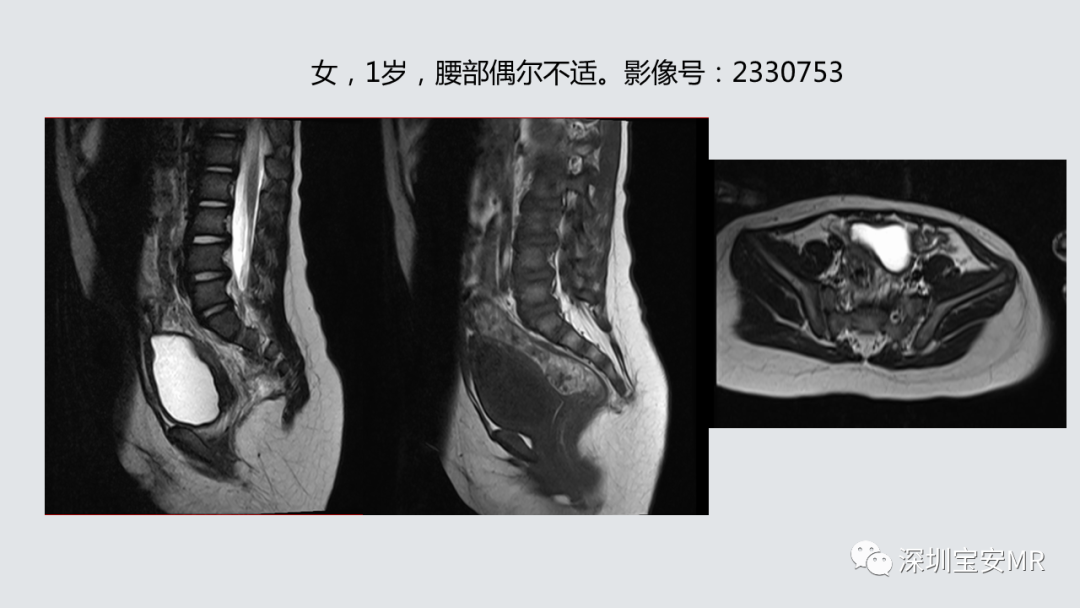 影像PPT - 【PPT】隐性神经管闭合不全的影像诊断-25