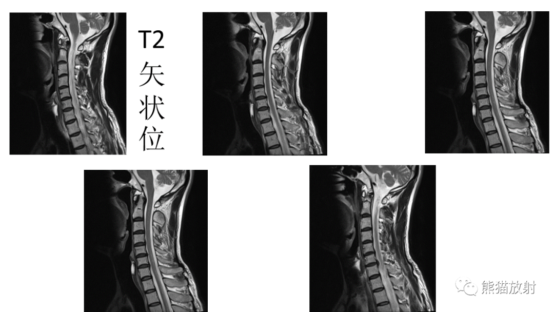 影像PPT - 【病例】脊髓亚急性联合变性2例MR-5