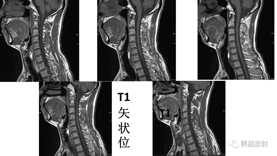 影像PPT - 【病例】脊髓亚急性联合变性2例MR-6