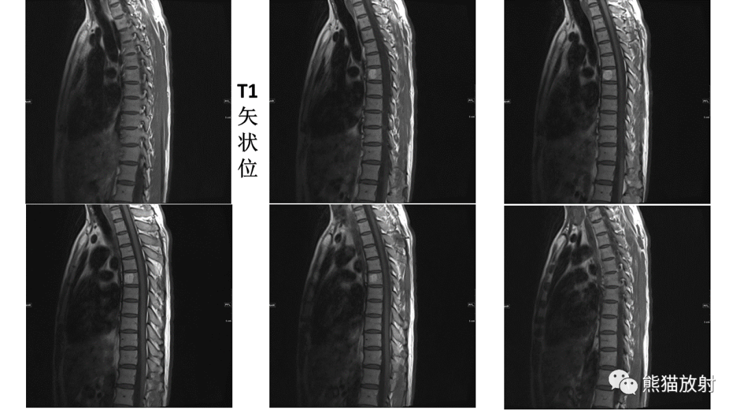 影像PPT - 【病例】脊髓亚急性联合变性2例MR-9