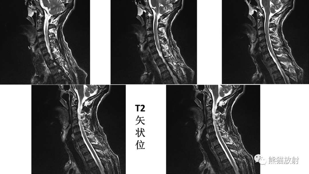影像PPT - 【病例】脊髓亚急性联合变性2例MR-16