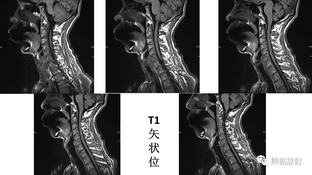 影像PPT - 【病例】脊髓亚急性联合变性2例MR-17