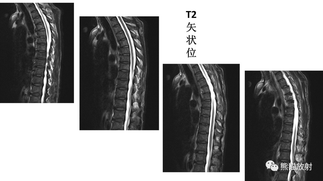 影像PPT - 【病例】脊髓亚急性联合变性2例MR-19