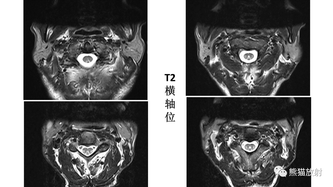 影像PPT - 【病例】脊髓亚急性联合变性2例MR-18