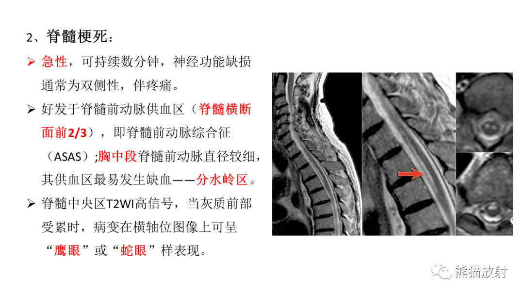影像PPT - 【病例】脊髓亚急性联合变性2例MR-28
