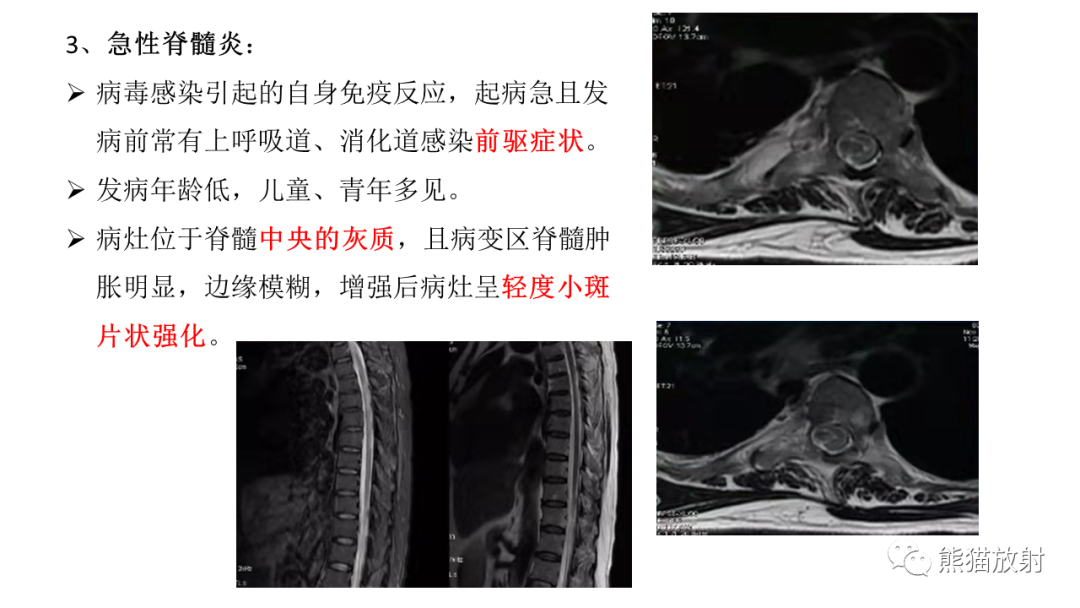 影像PPT - 【病例】脊髓亚急性联合变性2例MR-29