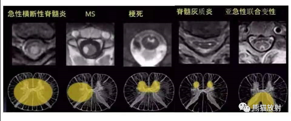 影像PPT - 【病例】脊髓亚急性联合变性2例MR-32