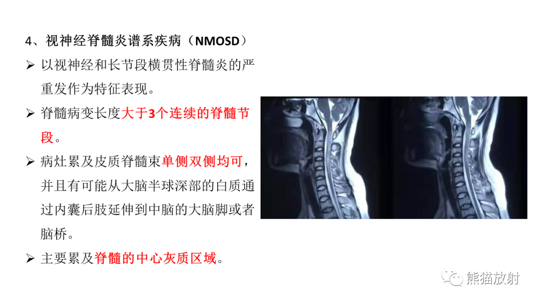 影像PPT - 【病例】脊髓亚急性联合变性2例MR-30
