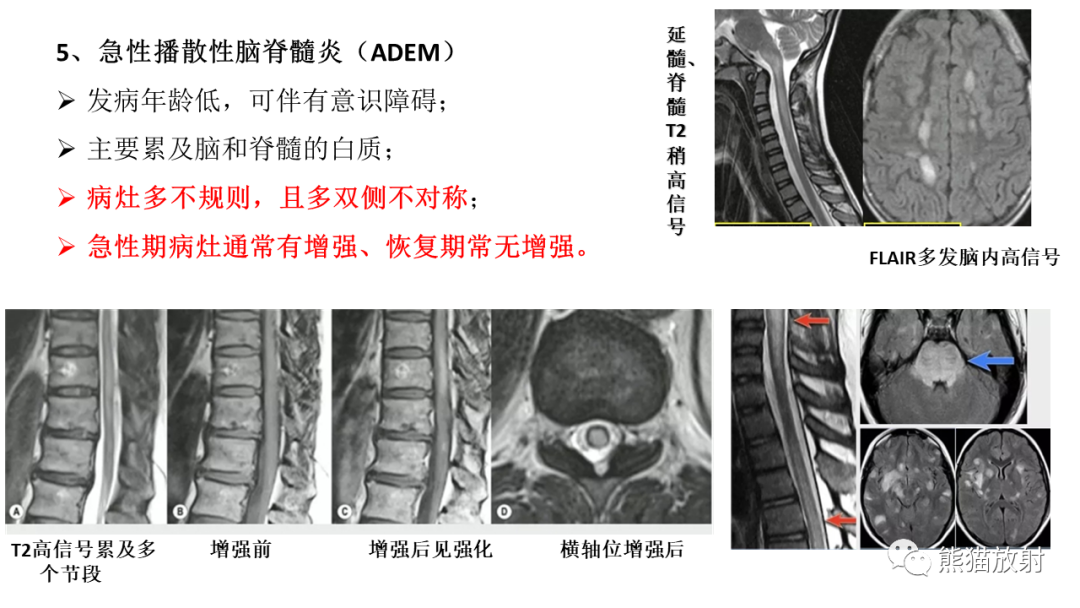 影像PPT - 【病例】脊髓亚急性联合变性2例MR-31
