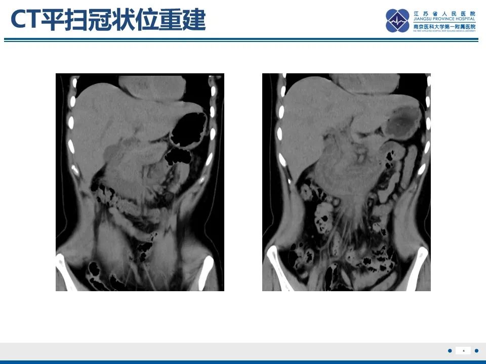影像PPT - 【PPT】腹型过敏性紫癜-5