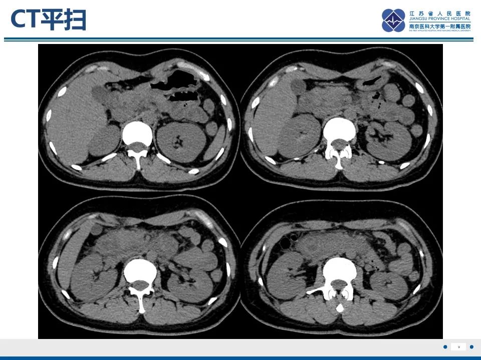 影像PPT - 【PPT】腹型过敏性紫癜-4