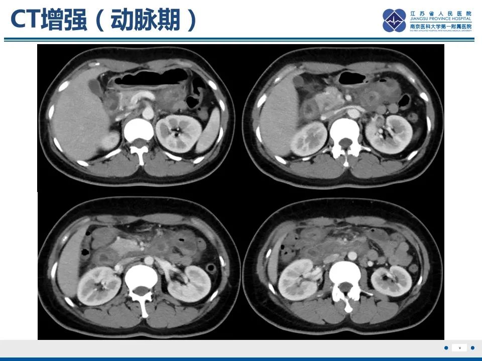 影像PPT - 【PPT】腹型过敏性紫癜-10