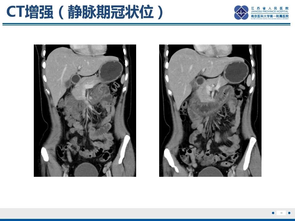 影像PPT - 【PPT】腹型过敏性紫癜-12