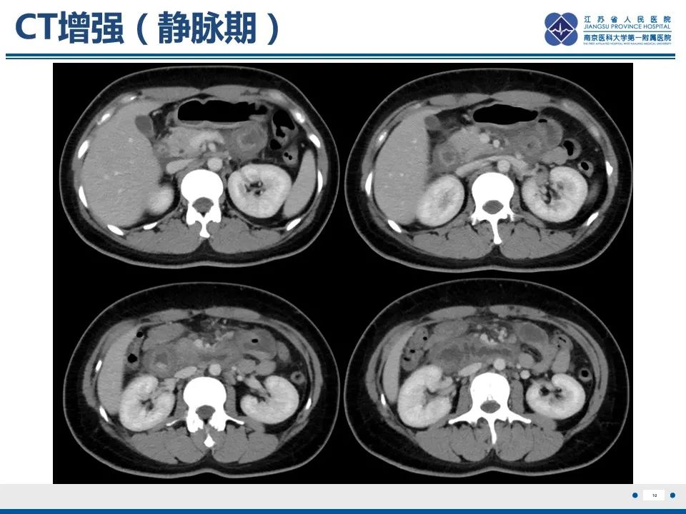 影像PPT - 【PPT】腹型过敏性紫癜-11