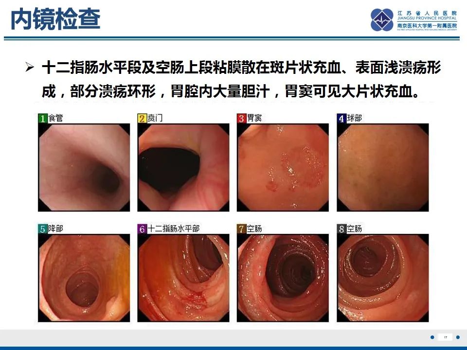 影像PPT - 【PPT】腹型过敏性紫癜-18