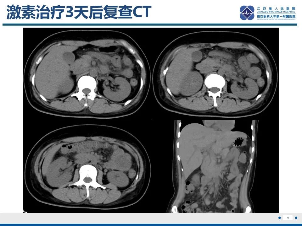 影像PPT - 【PPT】腹型过敏性紫癜-20