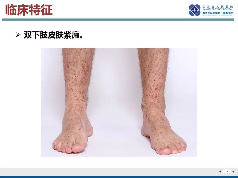 影像PPT - 【PPT】腹型过敏性紫癜-25
