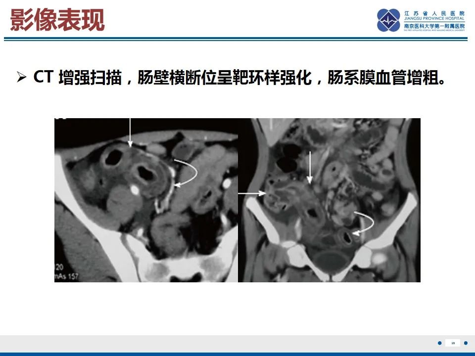 影像PPT - 【PPT】腹型过敏性紫癜-29