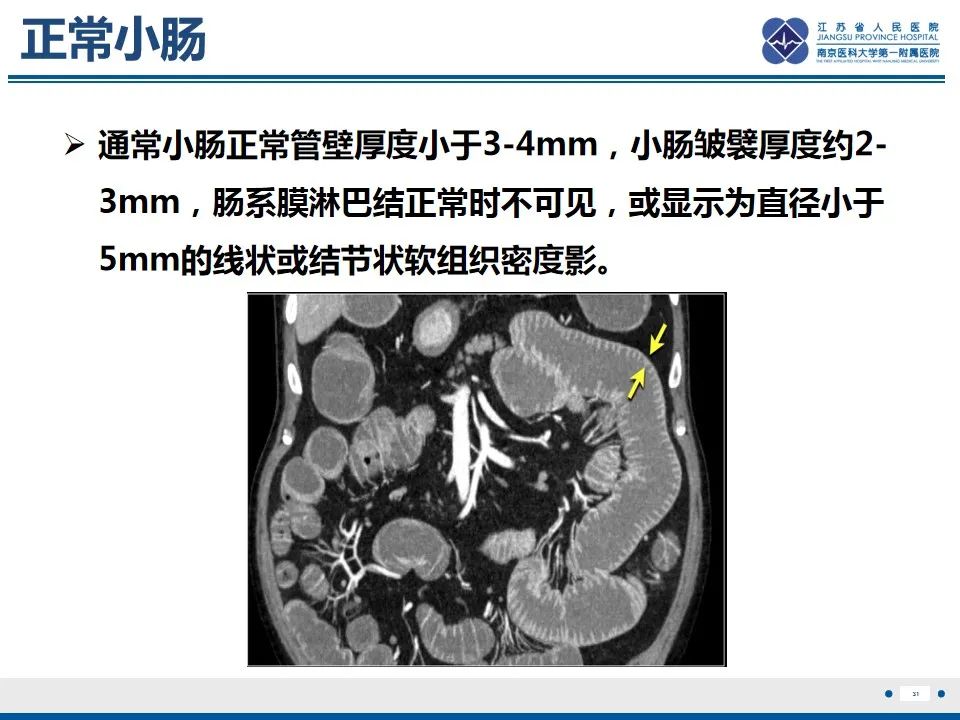 影像PPT - 【PPT】腹型过敏性紫癜-32
