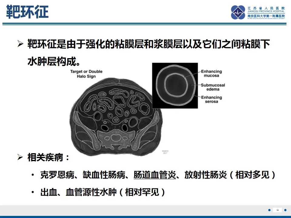 影像PPT - 【PPT】腹型过敏性紫癜-33