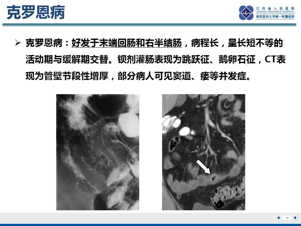 影像PPT - 【PPT】腹型过敏性紫癜-34
