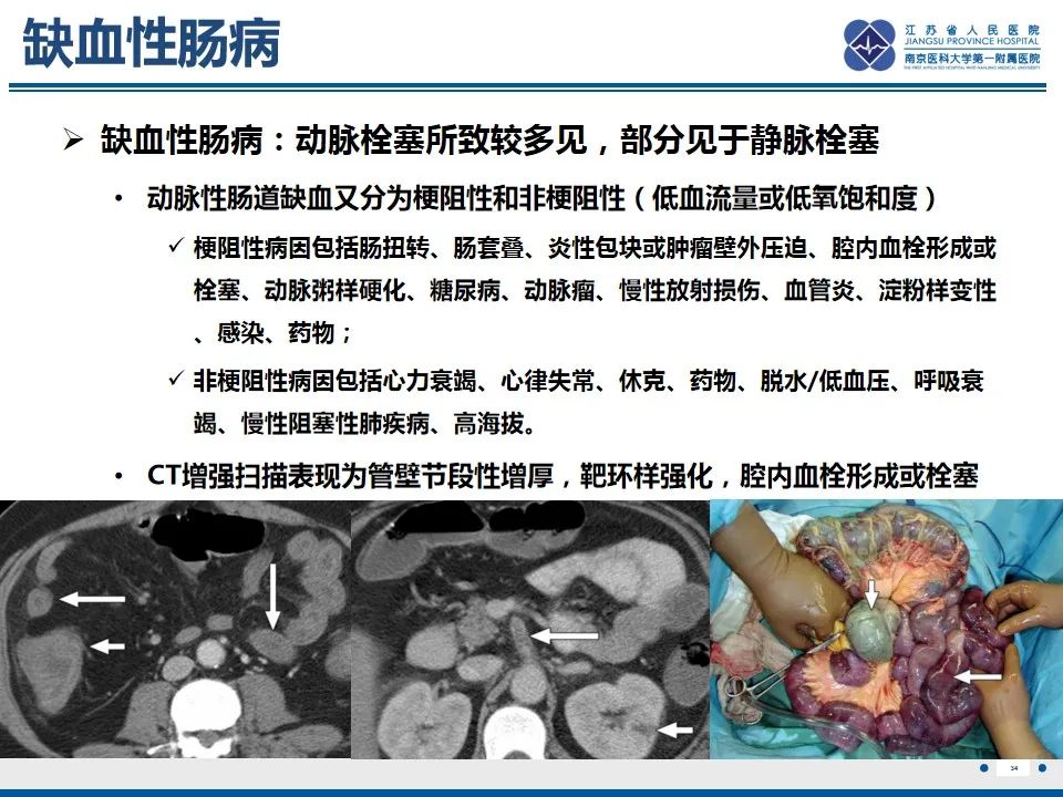 影像PPT - 【PPT】腹型过敏性紫癜-35
