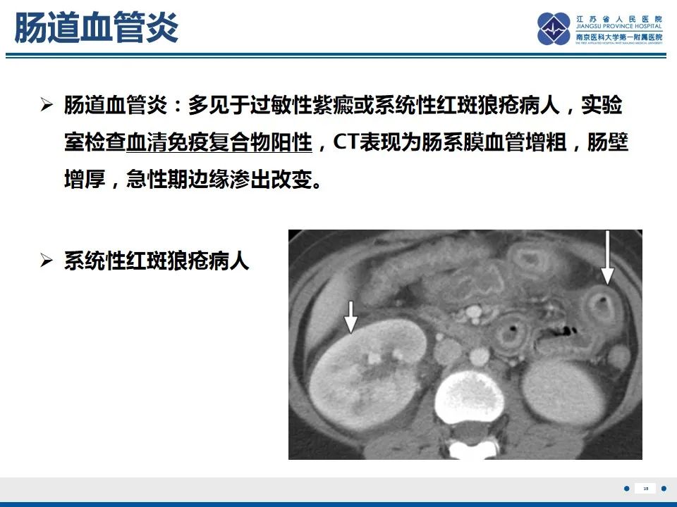 影像PPT - 【PPT】腹型过敏性紫癜-36