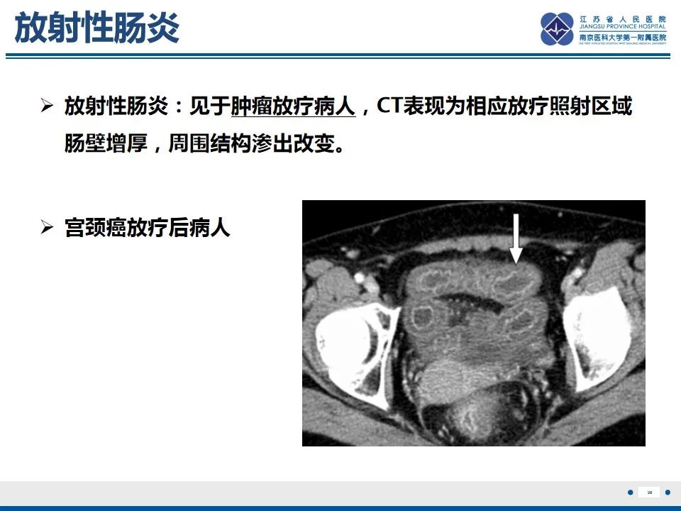 影像PPT - 【PPT】腹型过敏性紫癜-37
