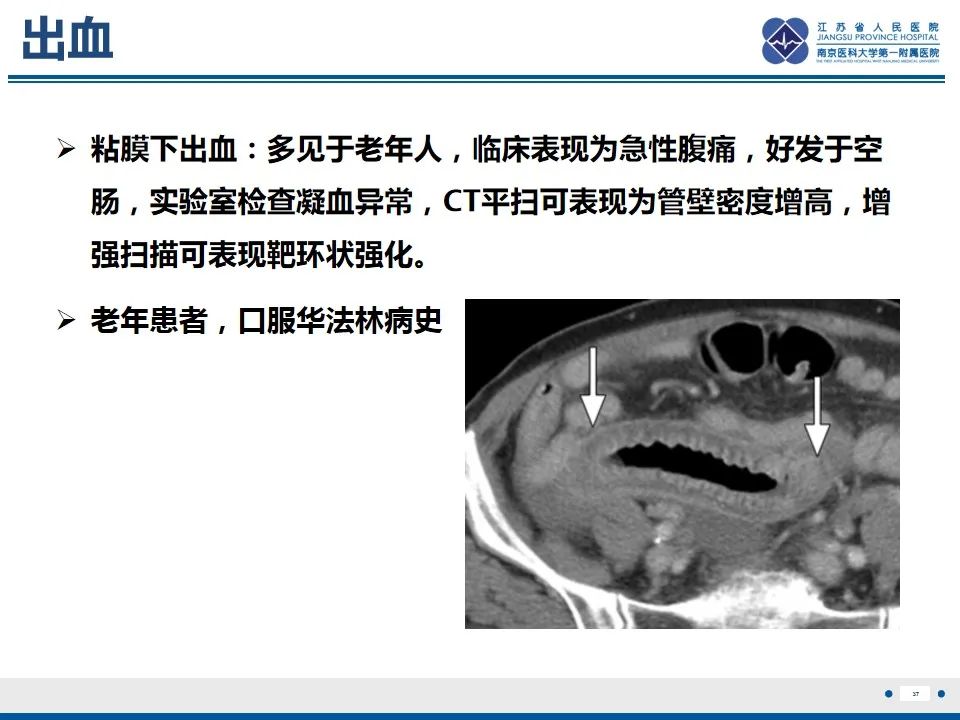 影像PPT - 【PPT】腹型过敏性紫癜-38