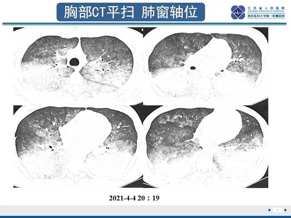 影像PPT - 【PPT】虫螨腈中毒-8