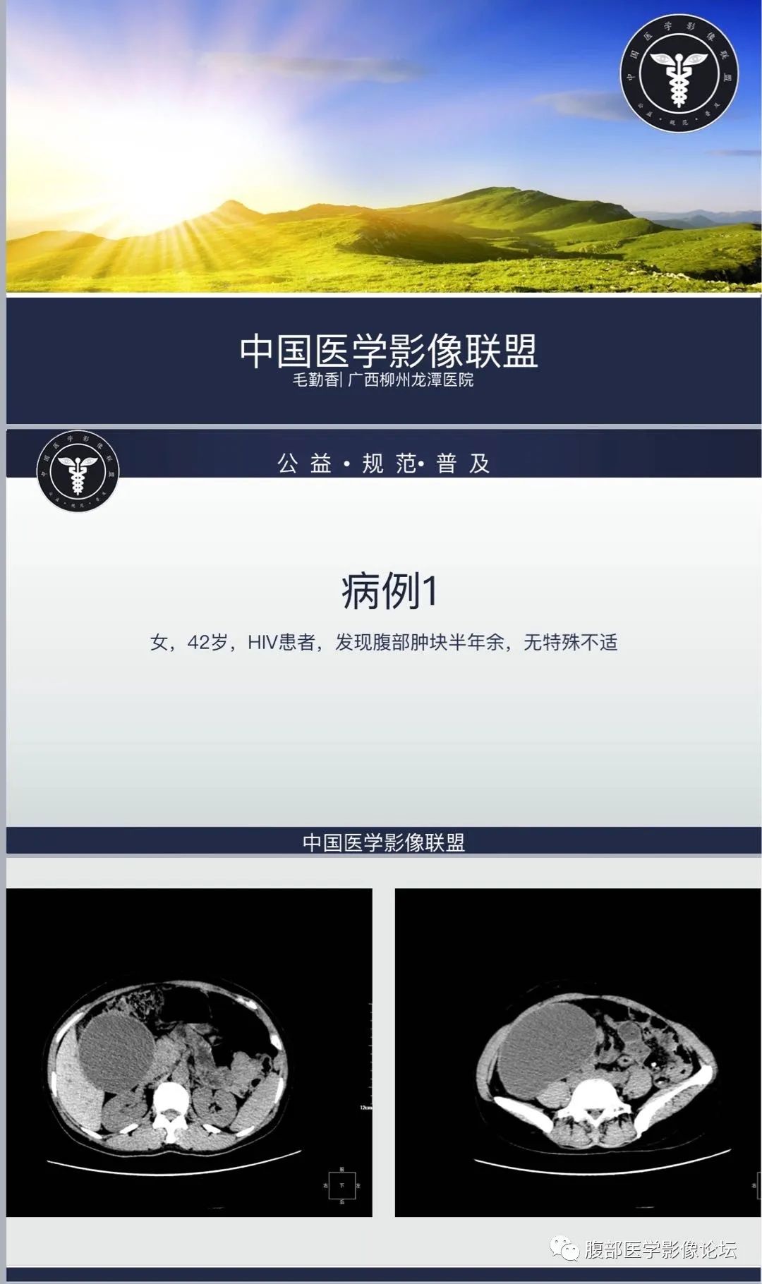影像PPT - 【病例】腹膜后黏液性囊腺瘤1例CT影像-1 影像PPT - 【病例】腹膜后黏液性囊腺瘤1例CT影像-1