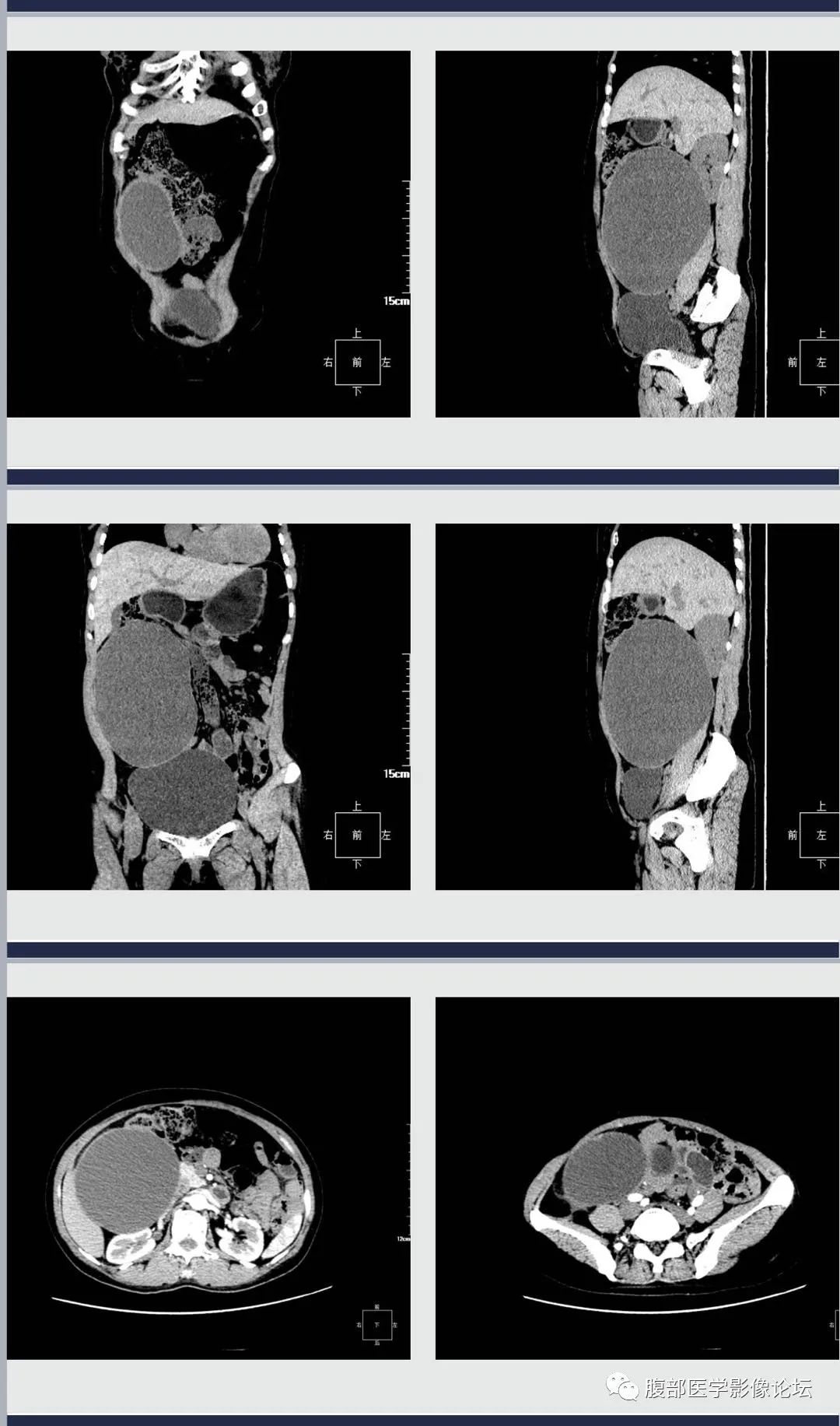 影像PPT - 【病例】腹膜后黏液性囊腺瘤1例CT影像-2 影像PPT - 【病例】腹膜后黏液性囊腺瘤1例CT影像-2