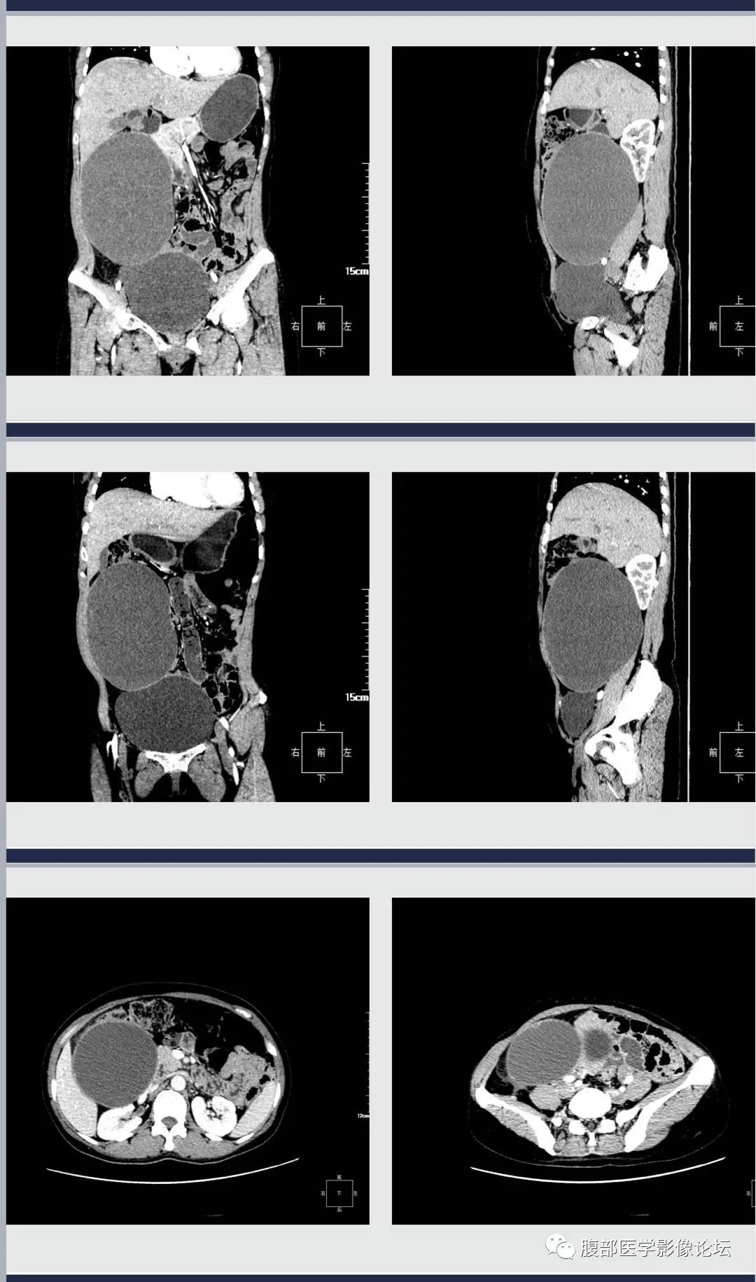 影像PPT - 【病例】腹膜后黏液性囊腺瘤1例CT影像-3 影像PPT - 【病例】腹膜后黏液性囊腺瘤1例CT影像-3