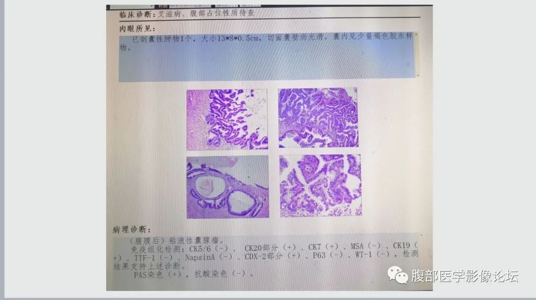 影像PPT - 【病例】腹膜后黏液性囊腺瘤1例CT影像-5 影像PPT - 【病例】腹膜后黏液性囊腺瘤1例CT影像-5
