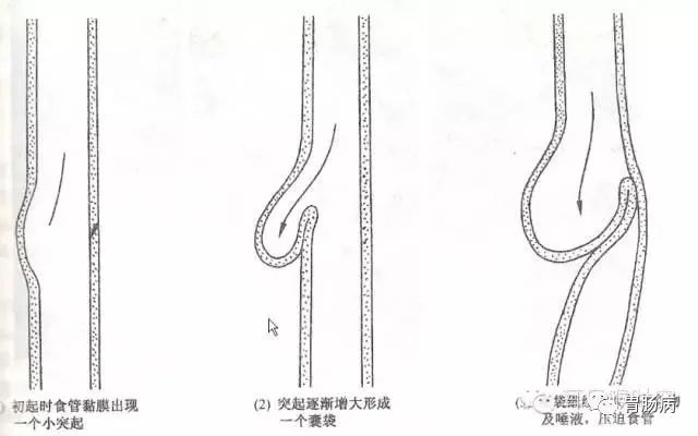 影像PPT - Zenker’s憩室（咽食管憩室）-2