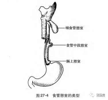 影像PPT - Zenker’s憩室（咽食管憩室）-4