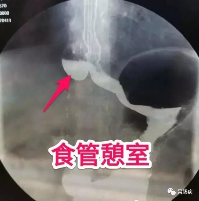 影像PPT - Zenker’s憩室（咽食管憩室）-5