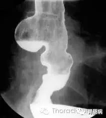 影像PPT - Zenker’s憩室（咽食管憩室）-6