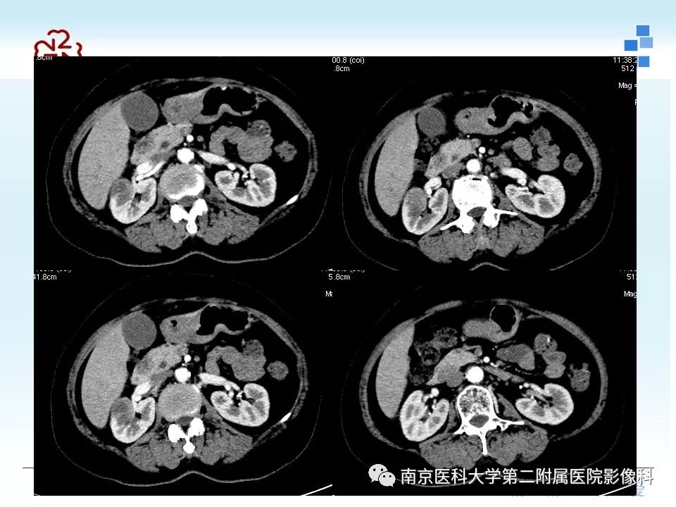 影像PPT - 【PPT】成人环状胰腺-4