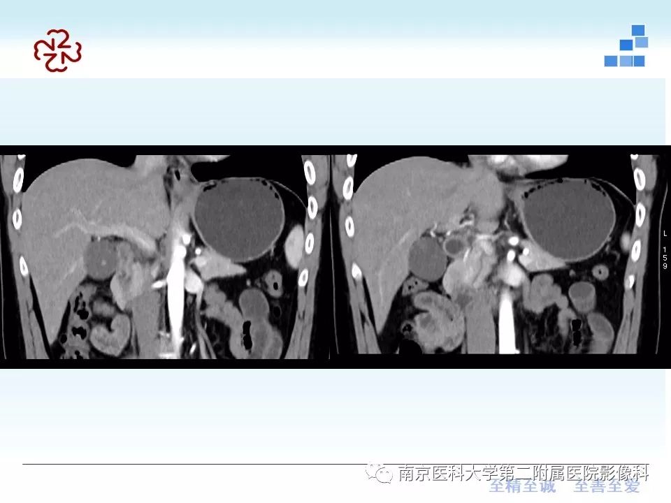 影像PPT - 【PPT】成人环状胰腺-15
